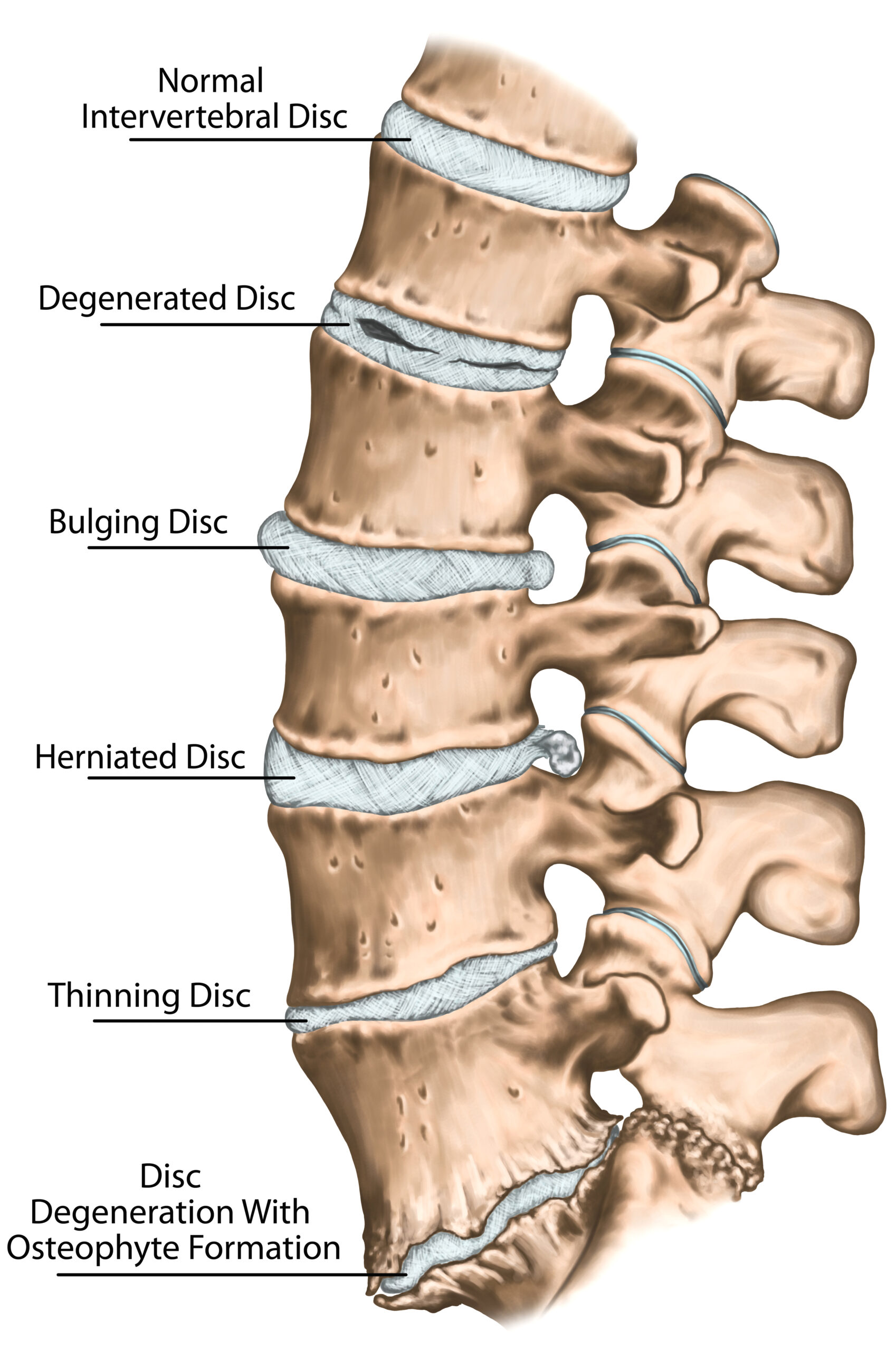Non-Surgical Spinal Decompression - Human spine showing various problems with the discs